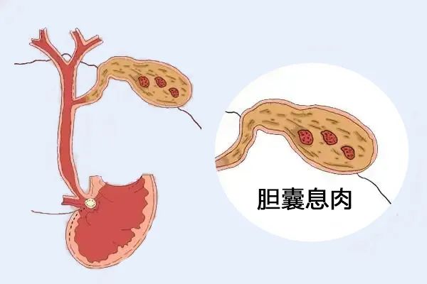 體檢出膽囊息肉，需要擔心嗎？