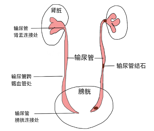 結(jié)石引發(fā)劇烈腎絞痛，該怎么辦？