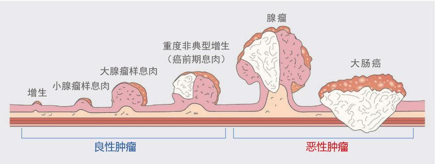 什么樣的腸息肉容易癌變？有一種要特別當心！