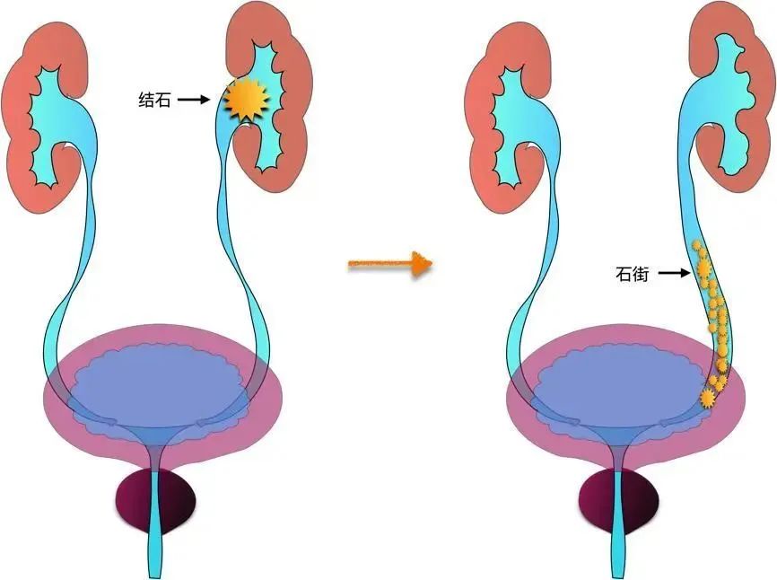 你經(jīng)歷過腎絞痛嗎？該如何緩解治療？